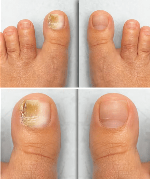 Feet Gungusa - prije i poslije liječenja s Fungeent Cream